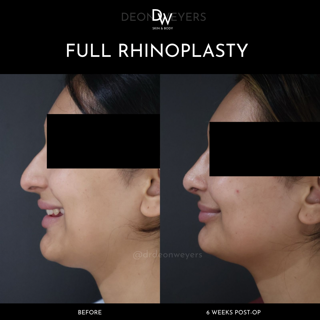 Rhinoplasty Before and After Photos Rhinoplasty Before and After Photos