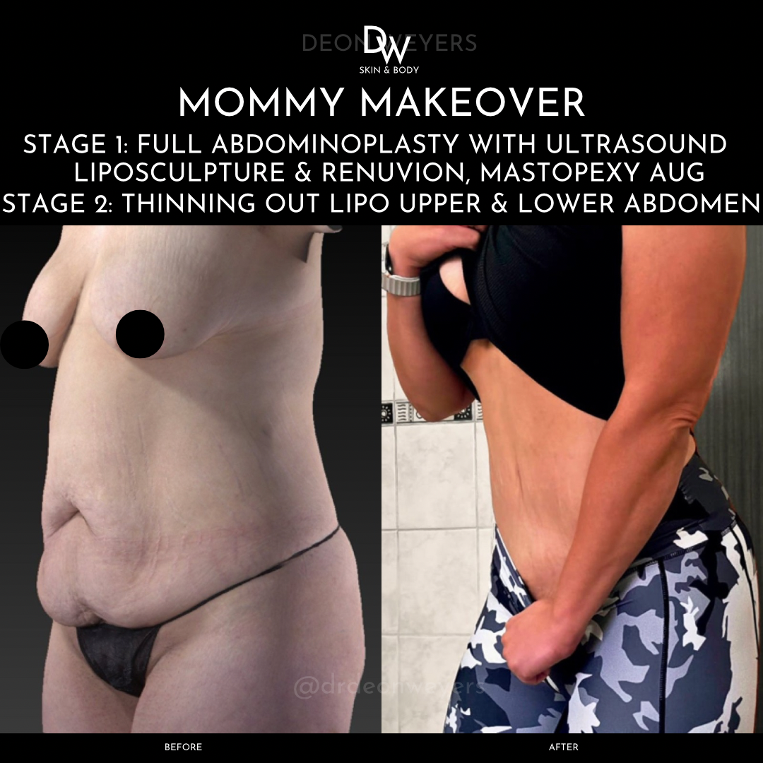 mommy makeover before and after photos Mommy Makeover Before and After Photo