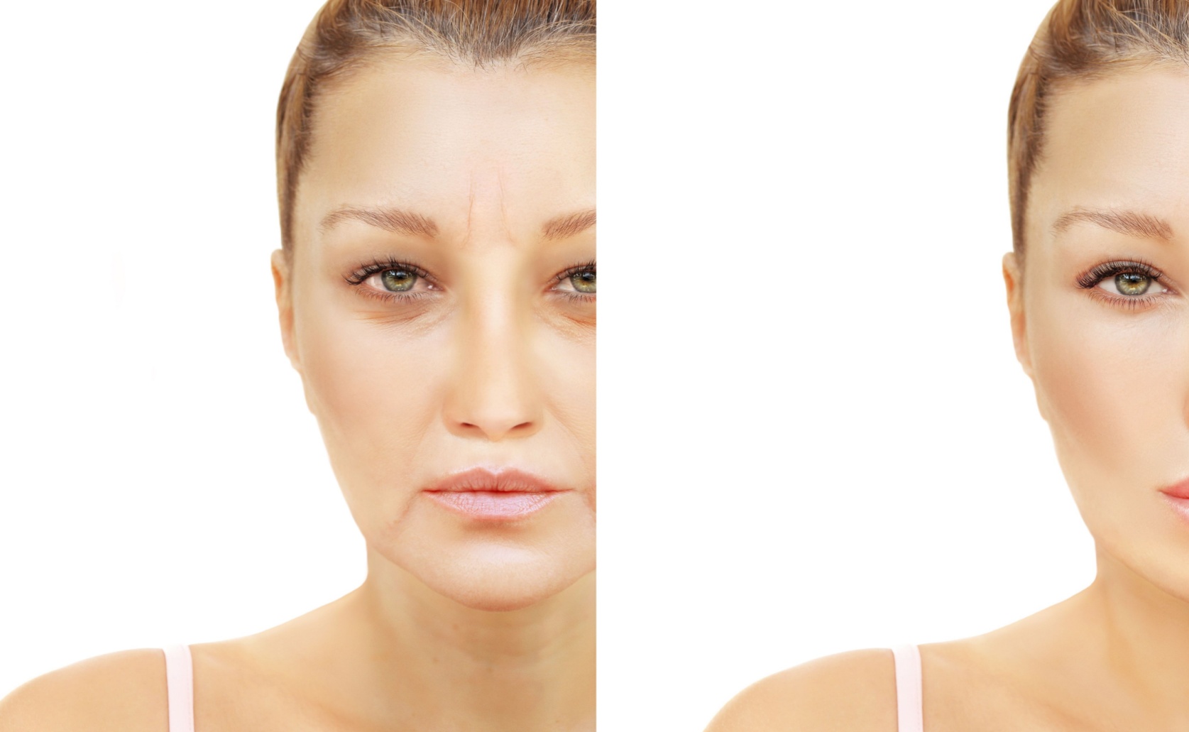 mini facelift before and after