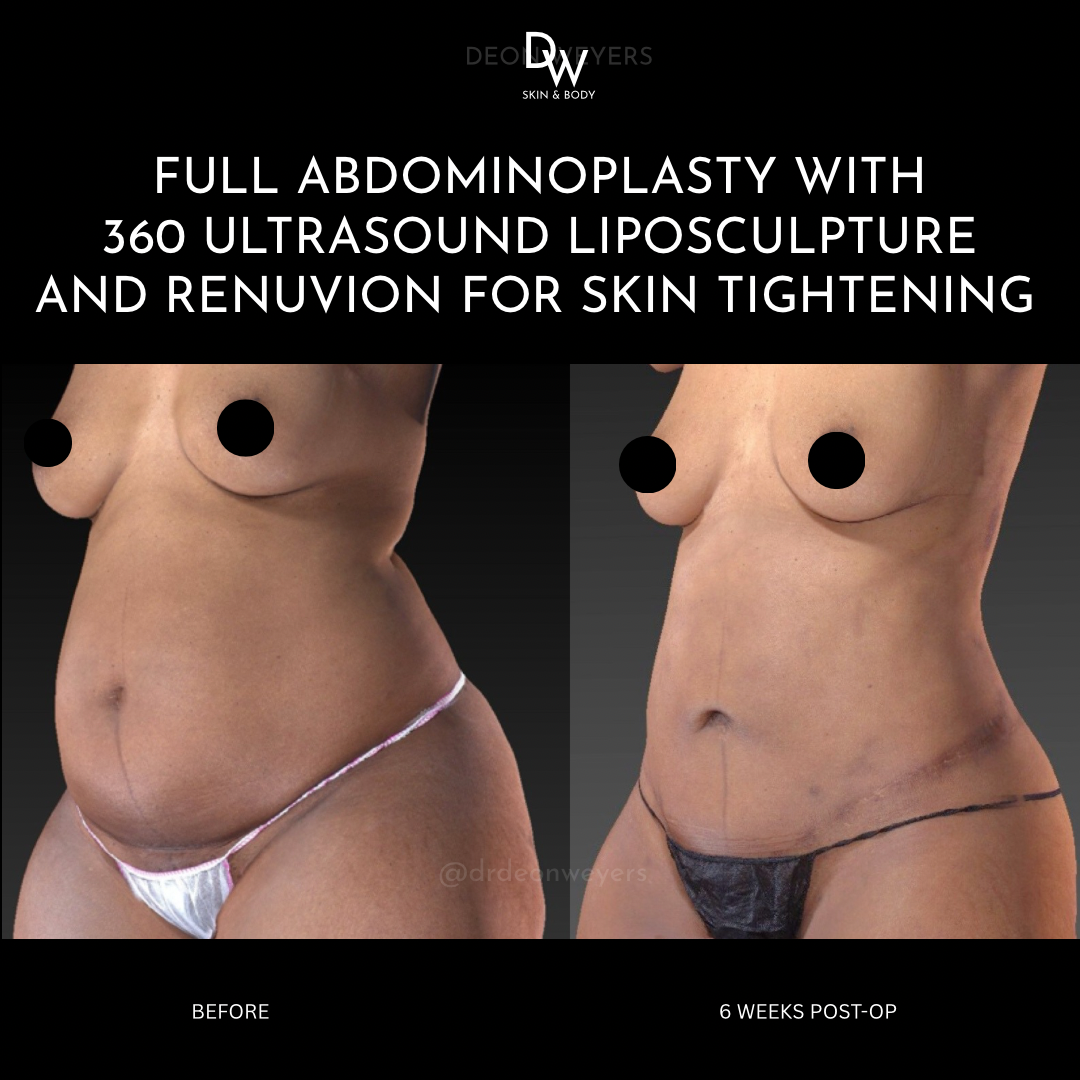 liposuction before and after photos