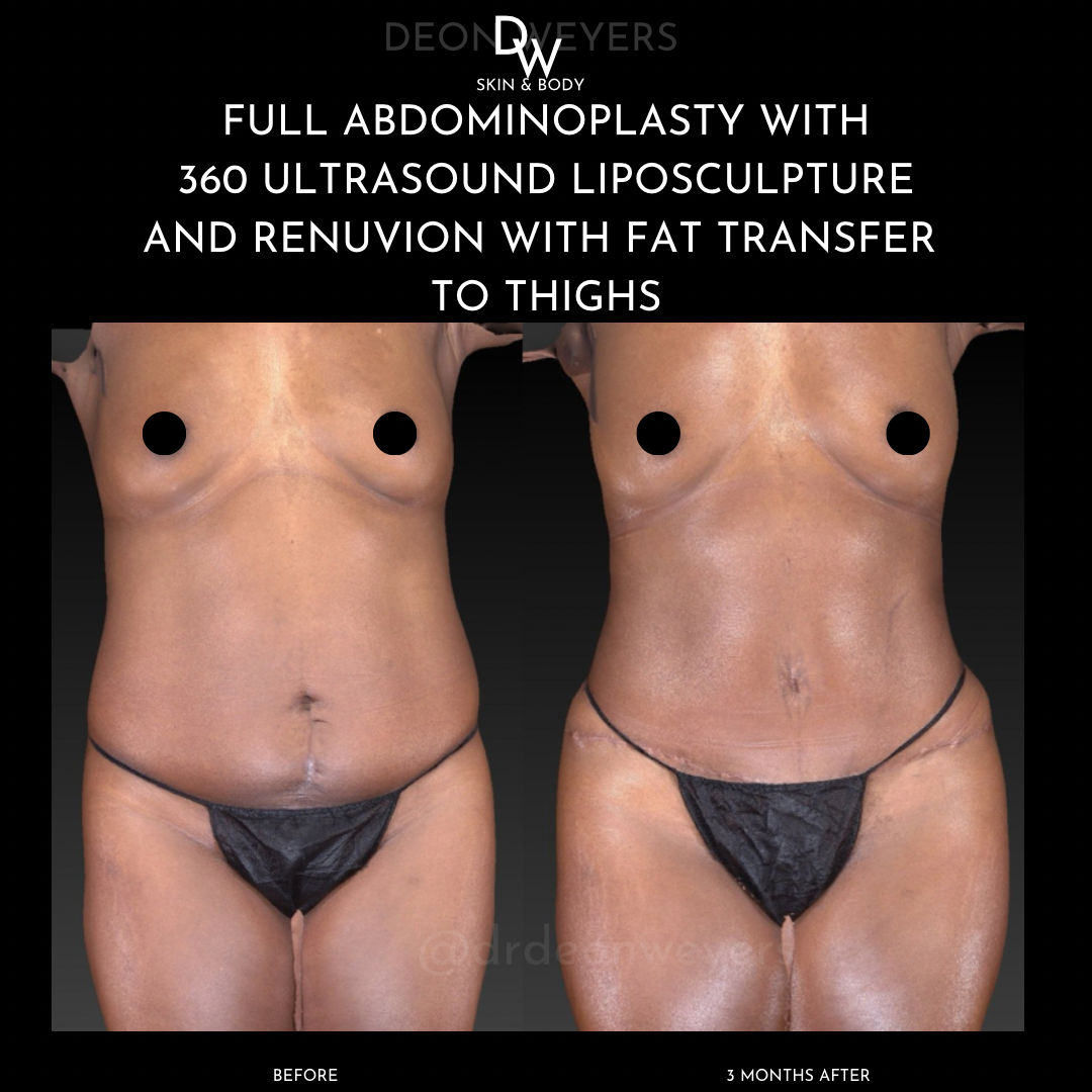 liposuction before and after photos