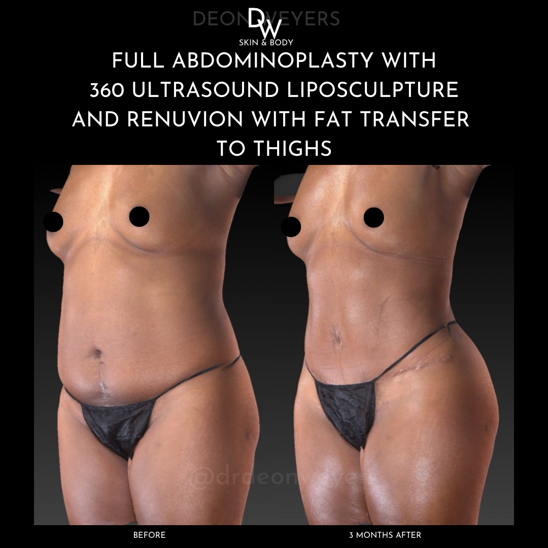 liposuction before and after photos