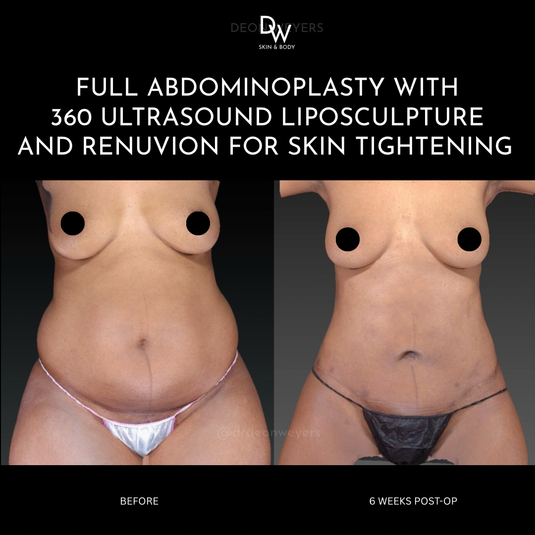 liposuction before and after photos