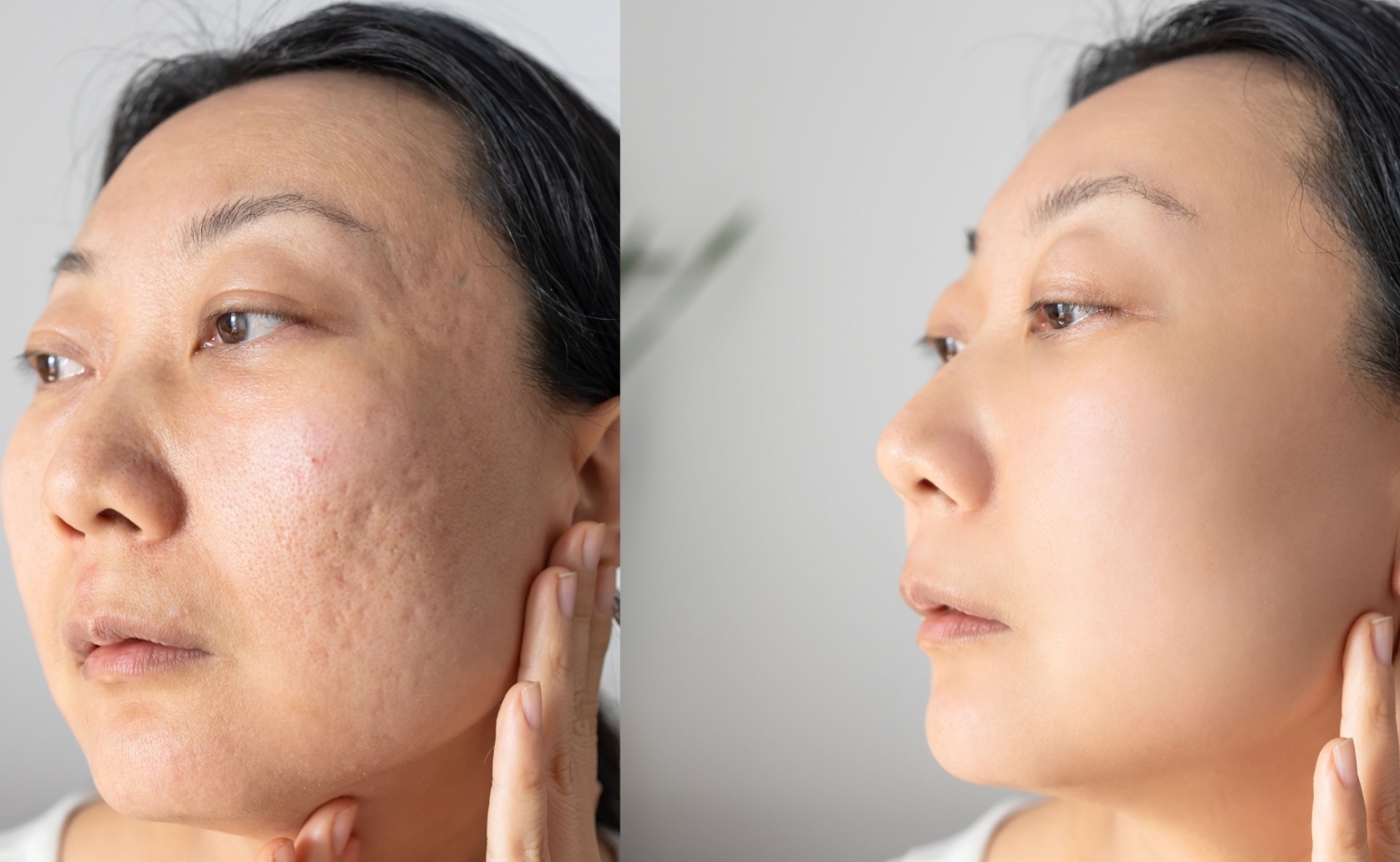 before after facelift
