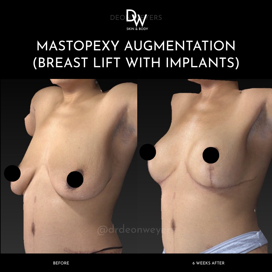 Breast Lift With Implants Before and After Photos