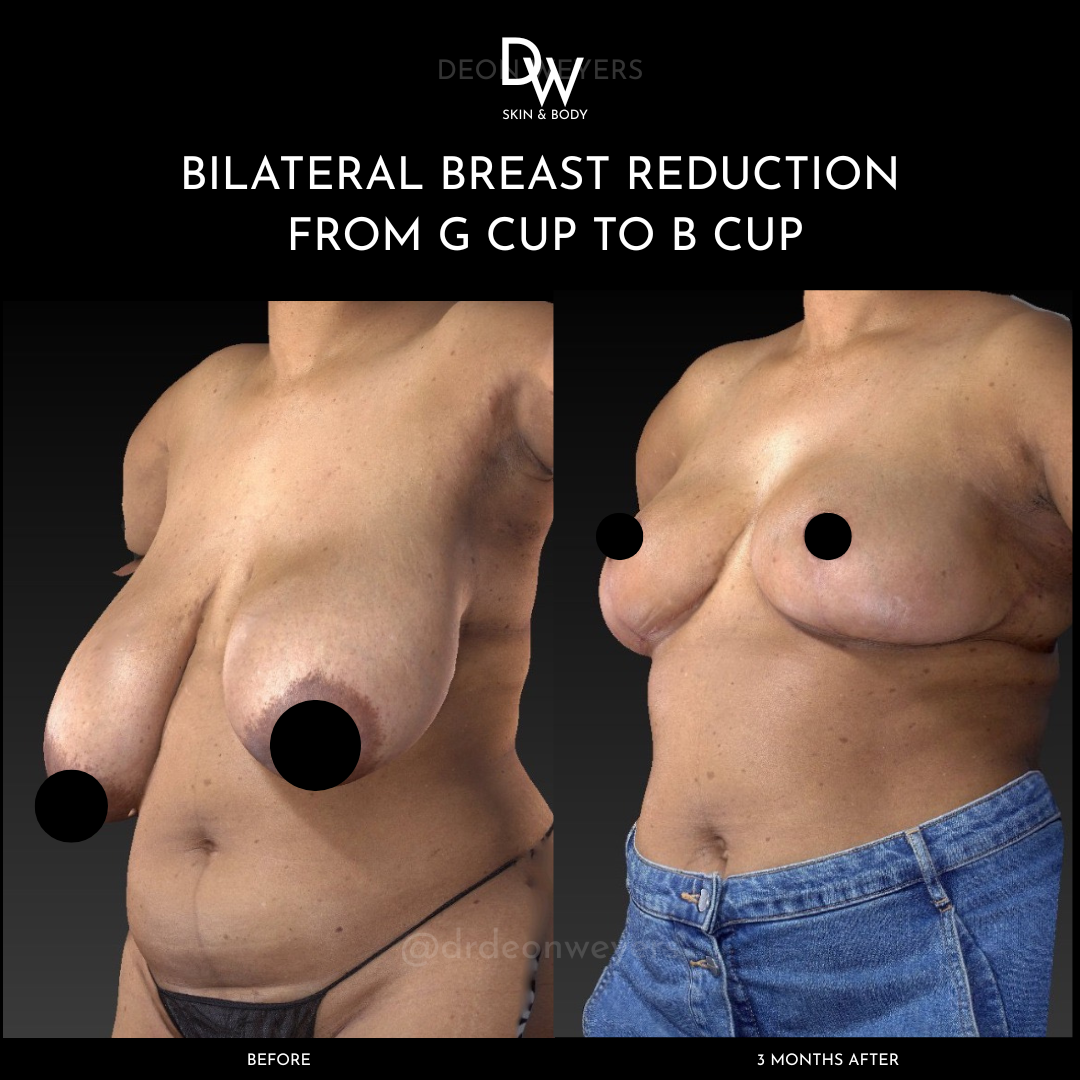 Breast Reduction Before and After Photos Breast Reduction Before And After Photos