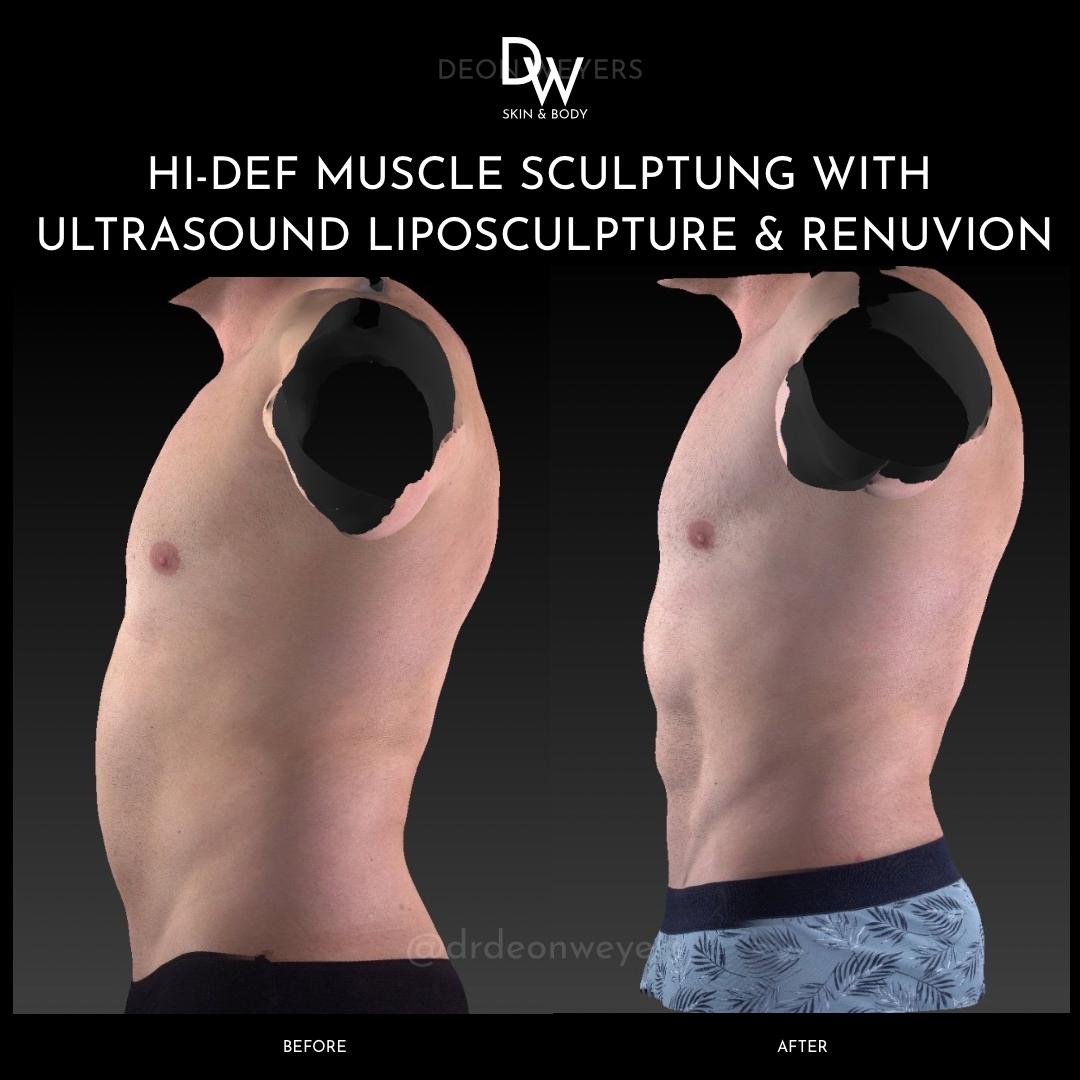 Male Surgery Before & After Photos Male Surgery BEFORE AND AFTER PHOTOS