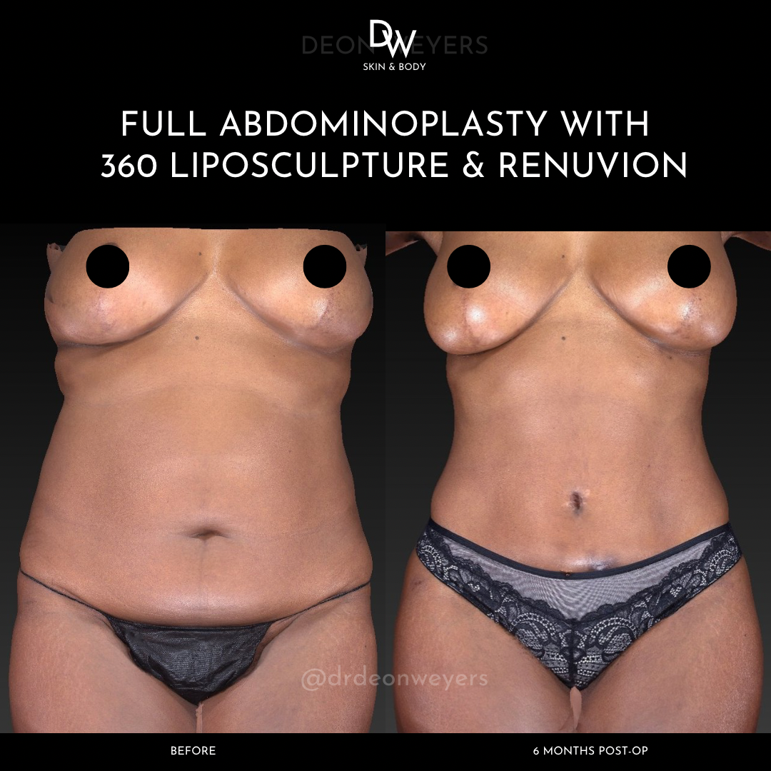 Abdominoplasty before and after photos Abdominoplasty Before and After Photo