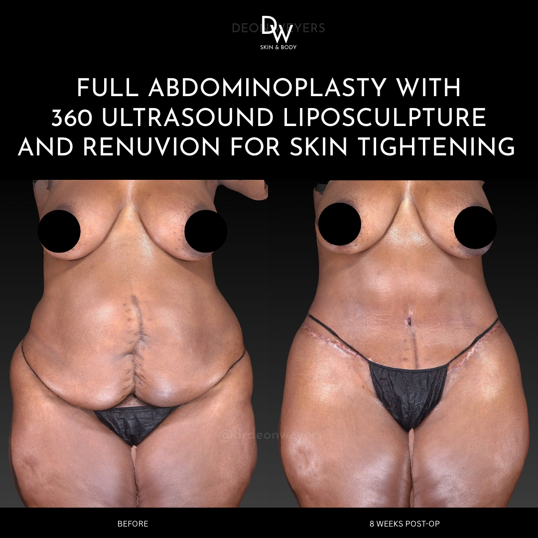 Abdominoplasty before and after photos Abdominoplasty Before and After Photo