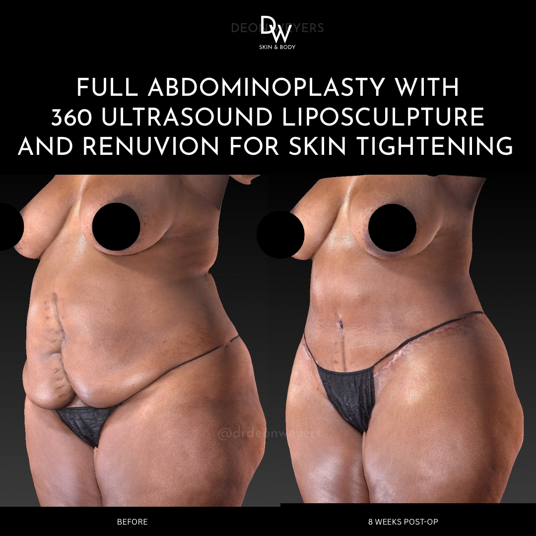 Abdominoplasty before and after photos Abdominoplasty Before and After Photo