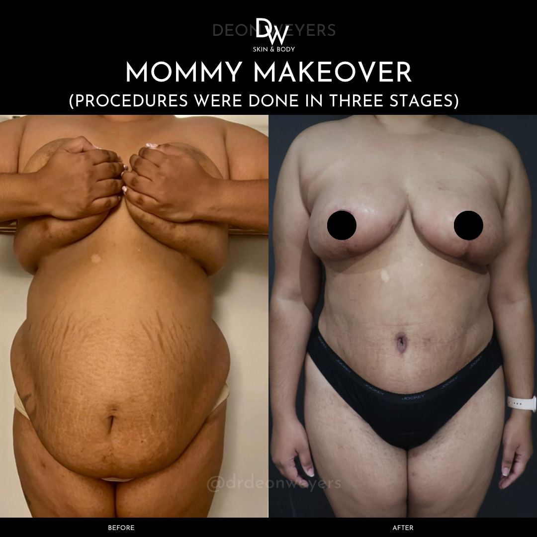 Abdominoplasty before and after photos Abdominoplasty Before and After Photo