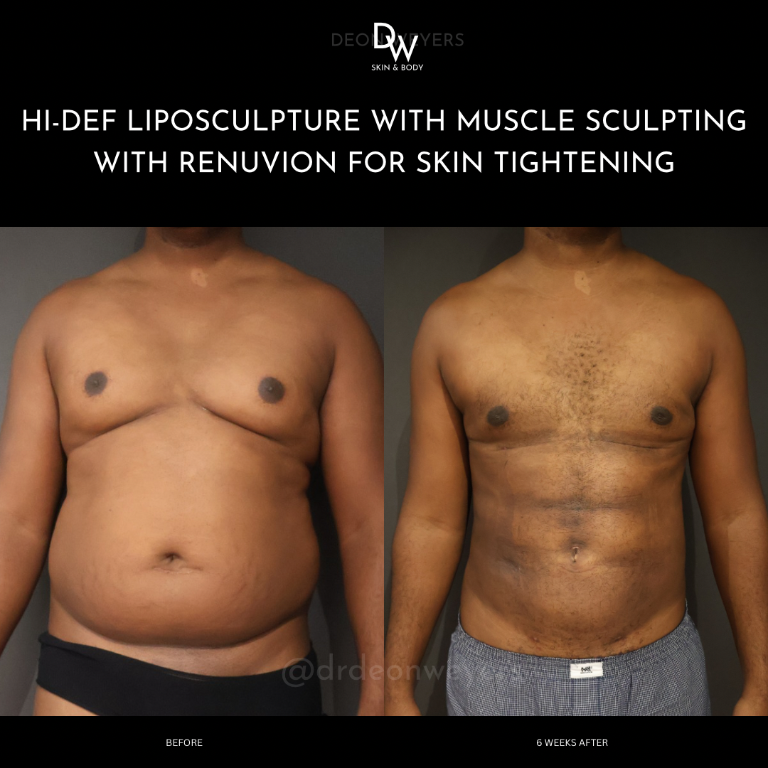Male Surgery Befor and After Images Male Surgery BEFORE AND AFTER PHOTOS