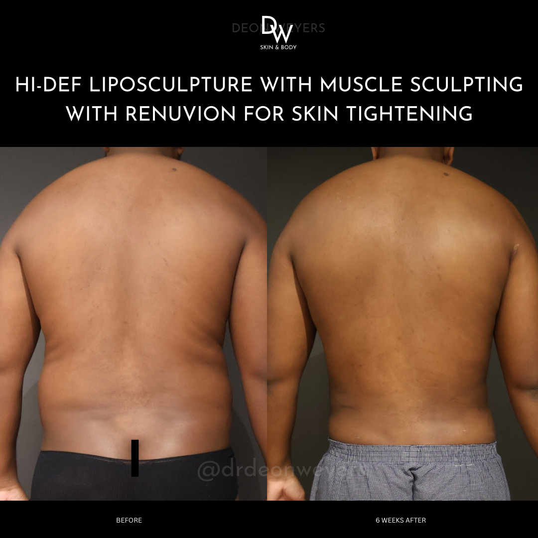 Male Surgery Before and After Images Male Surgery BEFORE AND AFTER PHOTOS