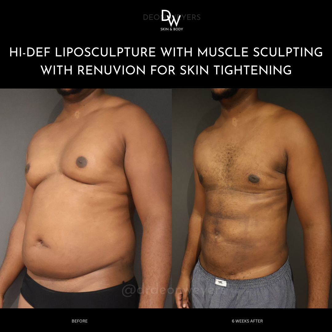 Male Surgery Before and After Images Male Surgery BEFORE AND AFTER PHOTOS