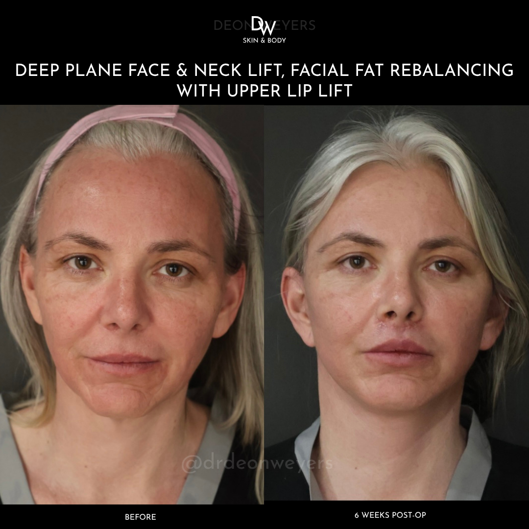 FACE & NECK LIFT BEFORE AND AFTER PHOTOS Facelift Before and After Photos