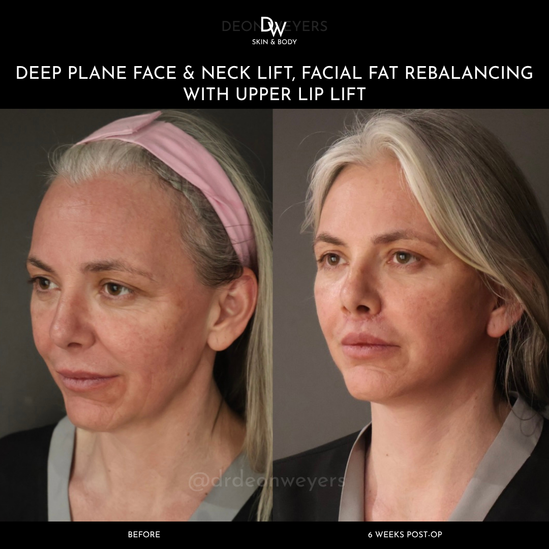FACE & NECK LIFT BEFORE AND AFTER PHOTOS Facelift Before and After Photos